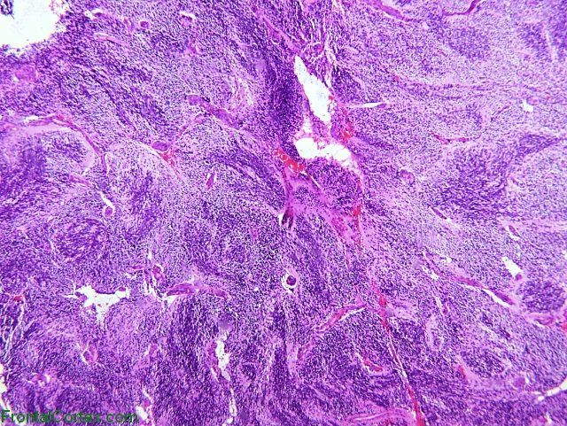 Medulloblastoma with extensive nodularity, H&E stain x 40